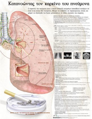 Ανατομικός χάρτης: κατανοώντας τον καρκίνο του πνεύμονα